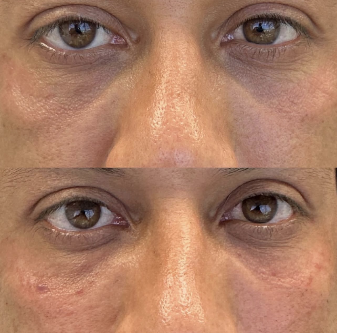 under-eye-correction Patient 4