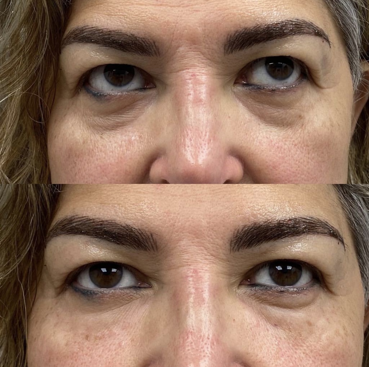 under-eye-correction Patient 3